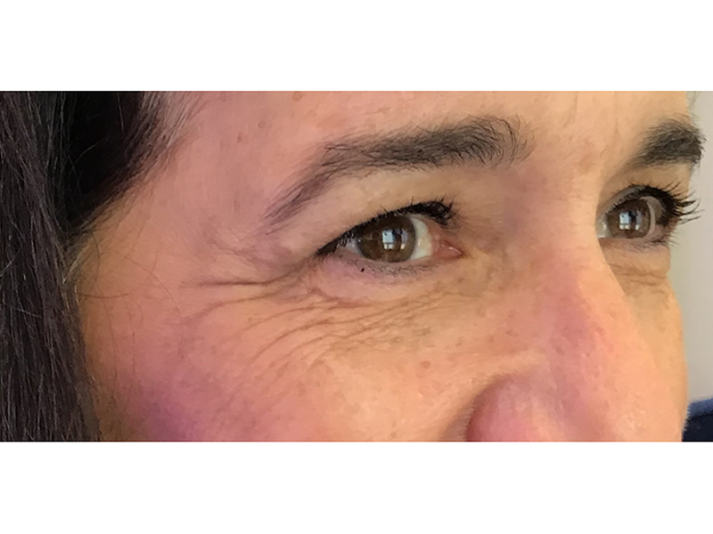 Botox Before and After | Forever Ageless Inc.