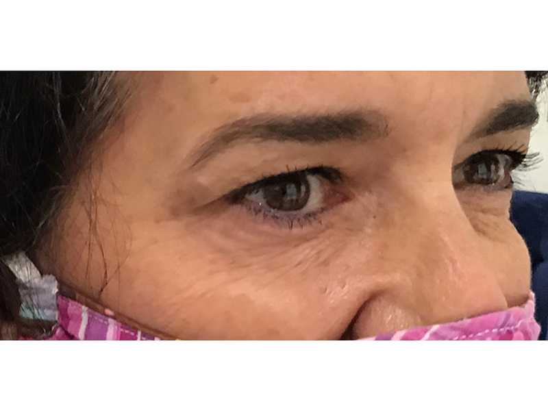 Botox Before and After | Forever Ageless Inc.