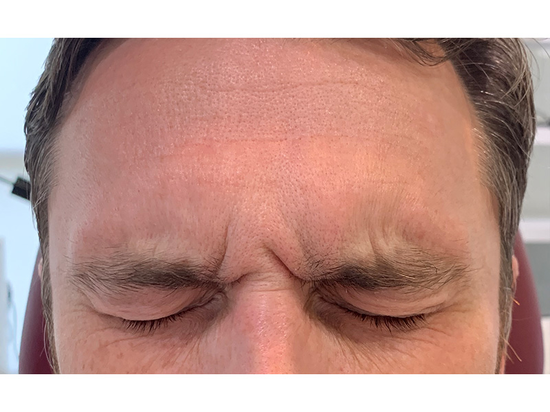 Botox Before and After | Forever Ageless Inc.