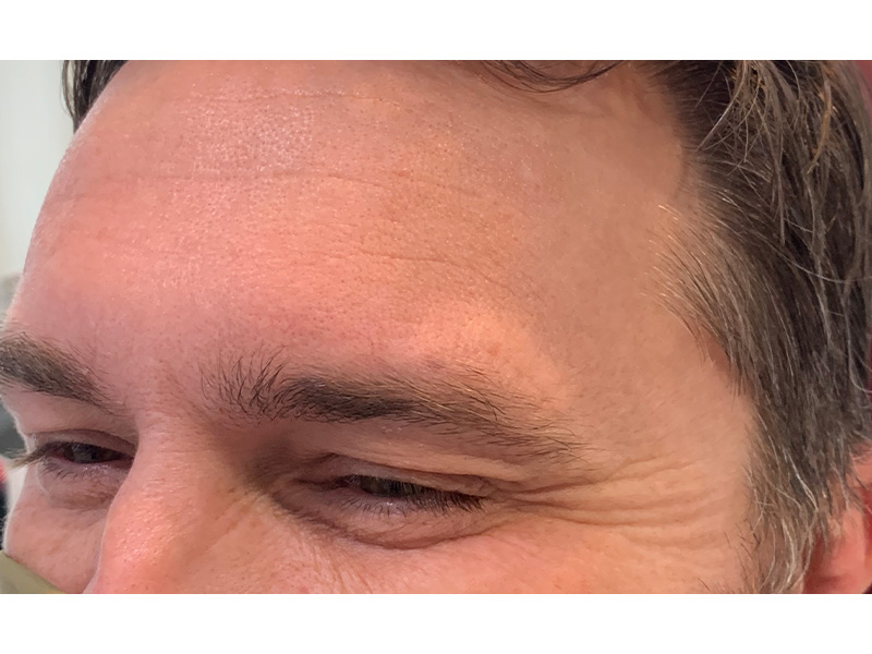 Botox Before and After | Forever Ageless Inc.