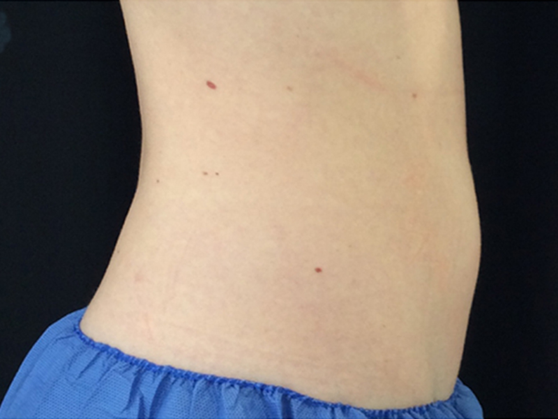 Coolsculpting Before and After | Forever Ageless Inc.