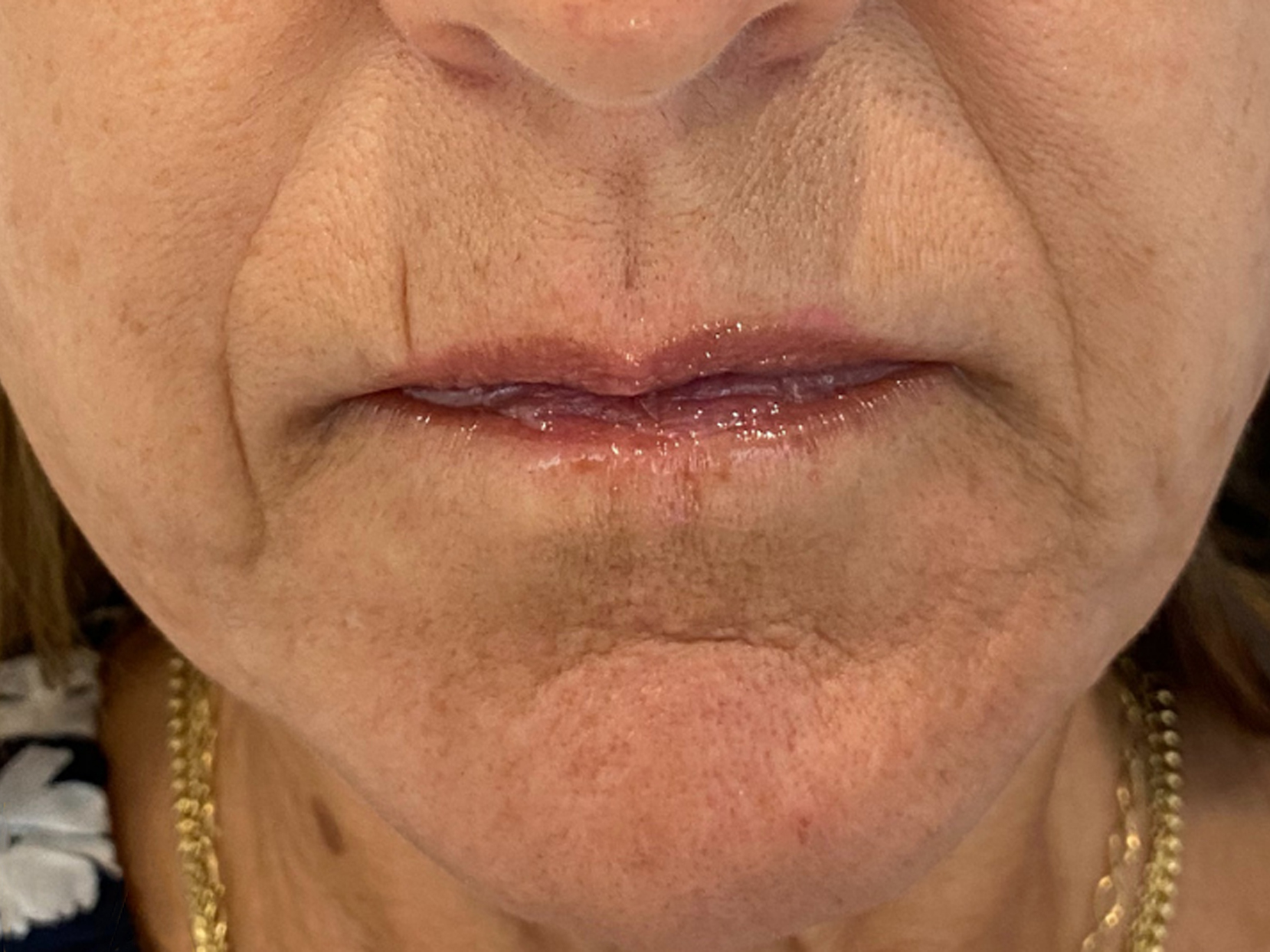 Dermal Filler Before and After | Forever Ageless Inc.