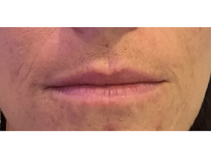 Dermal Filler Before and After | Forever Ageless Inc.