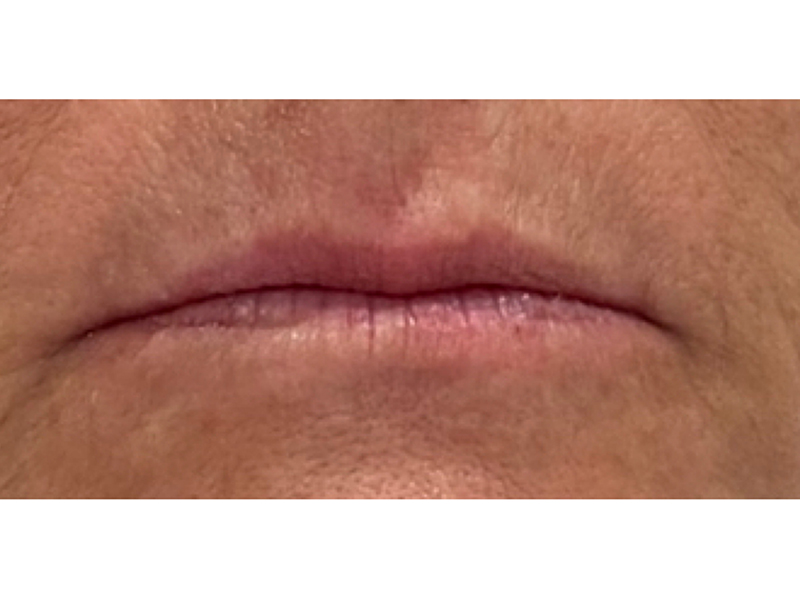 Dermal Filler Before and After | Forever Ageless Inc.