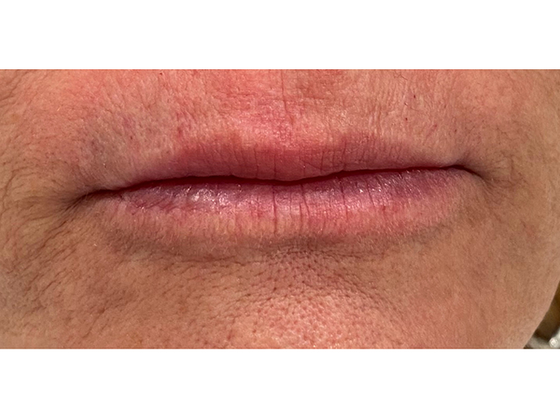 Dermal Filler Before and After | Forever Ageless Inc.