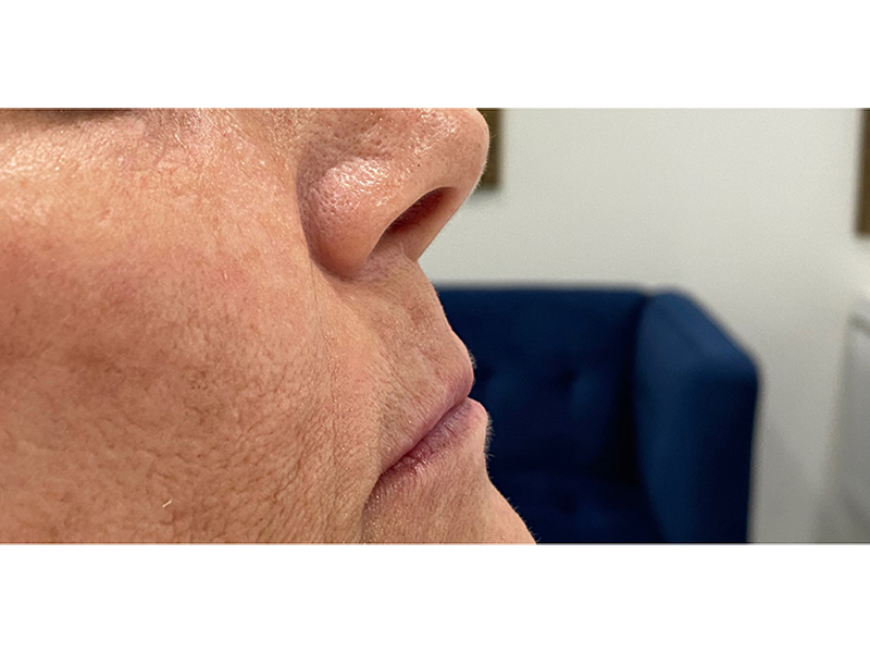 Dermal Filler Before and After | Forever Ageless Inc.