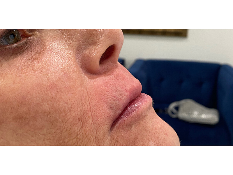 Dermal Filler Before and After | Forever Ageless Inc.