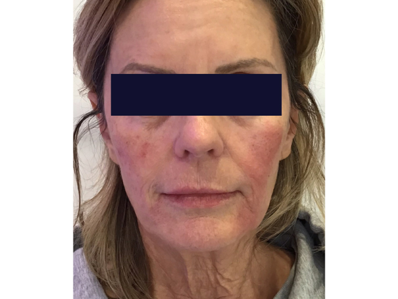 Dermal Filler Before and After | Forever Ageless Inc.