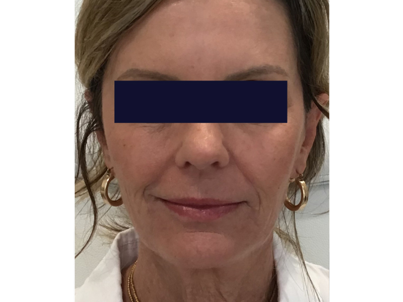 Dermal Filler Before and After | Forever Ageless Inc.