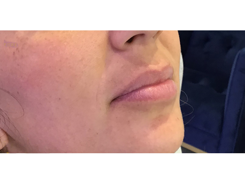 Dermal Filler Before and After | Forever Ageless Inc.