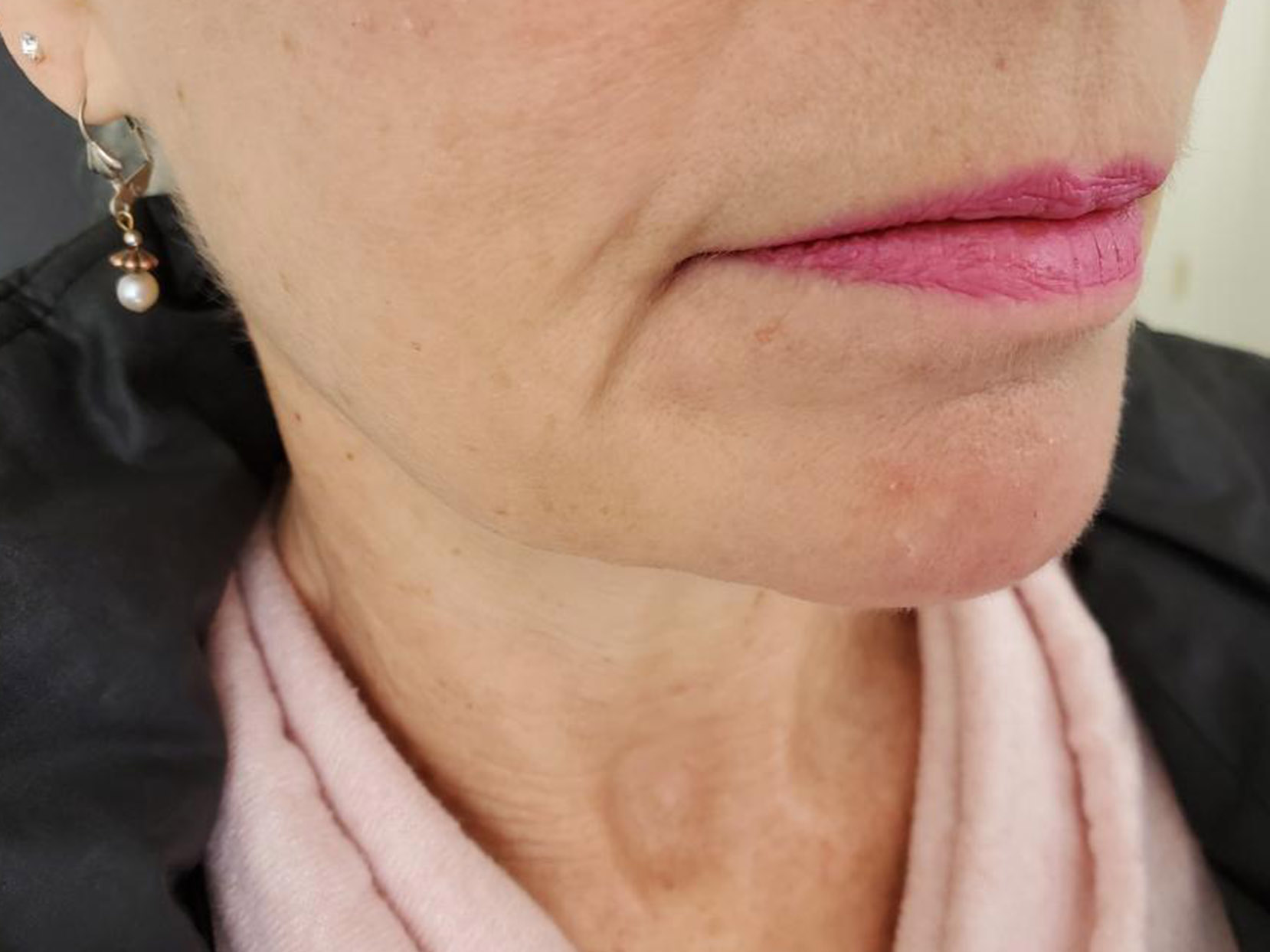 Dermal Filler Before and After | Forever Ageless Inc.