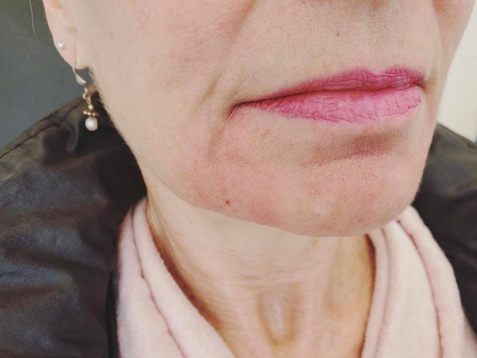 Dermal Filler Before and After | Forever Ageless Inc.