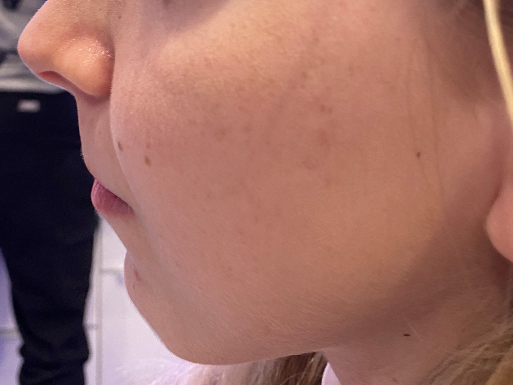 Dermal Filler Before and After | Forever Ageless Inc.