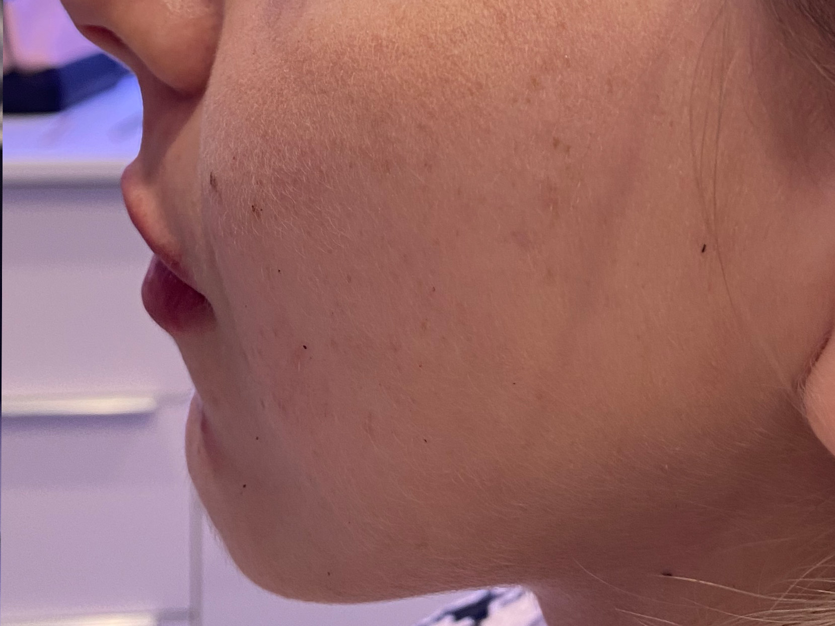 Dermal Filler Before and After | Forever Ageless Inc.