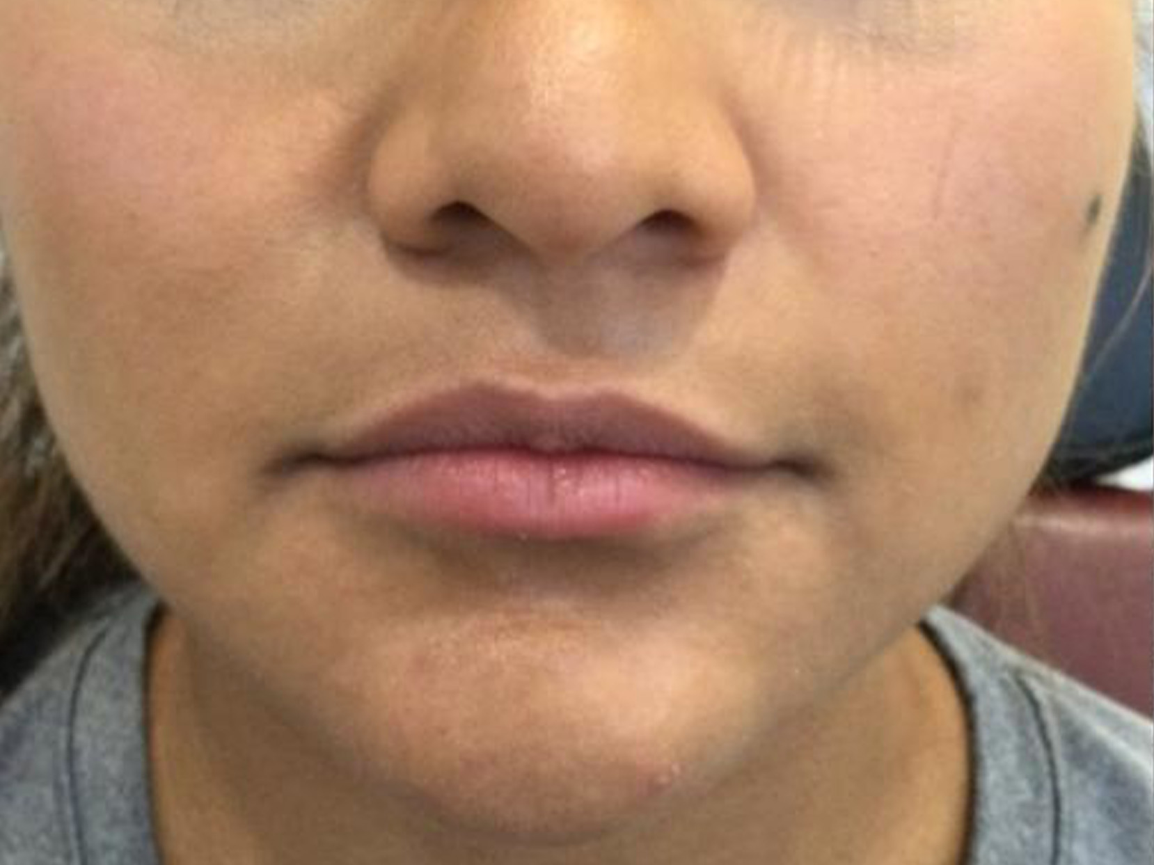 Dermal Filler Before and After | Forever Ageless Inc.